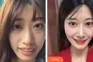 桂林美奧口腔門診部盧法汝整形價(jià)格表附牙齒矯正案例展示