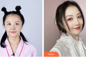 貴陽利美康醫(yī)院汪國應(yīng)整形價(jià)格表附植發(fā)案例展示