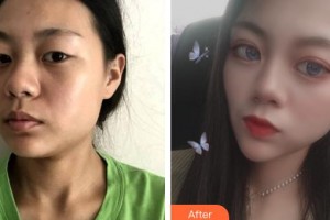 太原麗都整形美容醫(yī)院楊明鋒整形價格表附眼部綜合案例展示