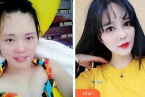 太原時光整形美容醫(yī)院杜凱娟整形價格表附眼部綜合案例展示