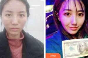 太原美媛薈整形美容醫(yī)院李燕整形價格表附埋線提升案例展示