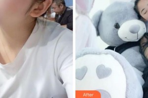 太原麗都整形美容醫(yī)院張德勇整形價格表附激光美膚激光案例展示