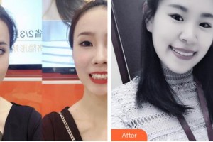 太原麗都整形美容醫(yī)院郭亞杰整形價格表附牙齒隱形矯正案例展示