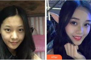 太原晉綺醫(yī)療美容診所詹本立整形價格表附激光去眼袋案例展示