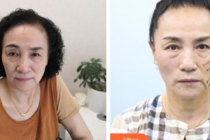 太原歐美蓮整形美容醫(yī)院李永生整形價格表附埋線提升案例展示