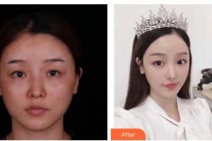 太原傾城醫(yī)療美容醫(yī)院張光文整形價格表附激光去眼袋案例展示