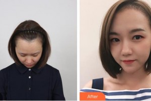 太原顯微手外科醫(yī)院毛發(fā)移植中心王亞麗整形價格表附美人尖種植案例展示