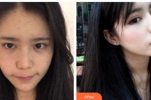 太原麗都整形美容醫(yī)院趙霞整形價格表附激光美膚激光案例展示