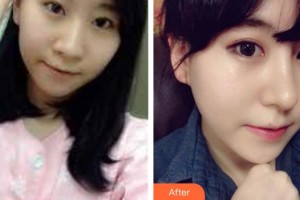 太原麗都整形美容醫(yī)院楊順新院長整形價格表附鼻部綜合案例展示