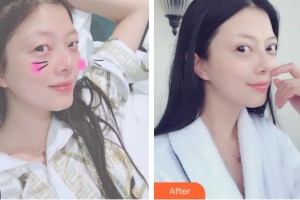 太原愛爾眼科醫(yī)院李晉華整形價格表附切開雙眼皮案例展示