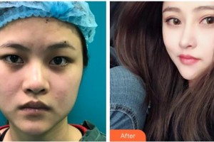 太原愛爾眼科醫(yī)院張嵐整形價格表附切開雙眼皮案例展示