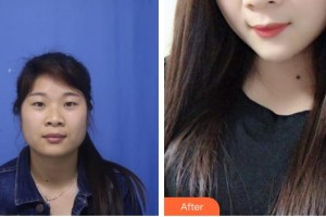 太原華美整形美容醫(yī)院張鵬云整形價格表附定點(diǎn)雙眼皮案例展示