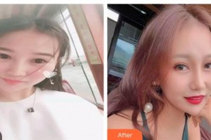 太原愛爾眼科醫(yī)院劉利整形價格表附眼部綜合案例展示