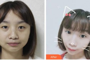 太原愛爾眼科醫(yī)院朱彬整形價格表附定點(diǎn)雙眼皮案例展示