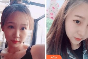 太原愛爾眼科醫(yī)院郝艷君整形價格表附切開雙眼皮案例展示