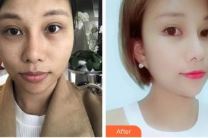 太原愛爾眼科醫(yī)院劉新榮整形價格表附眼部綜合案例展示