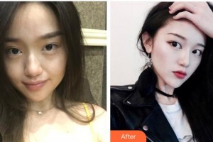 太原時光整形美容醫(yī)院張國軍整形價格表附埋線提升案例展示