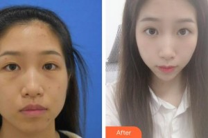 太原愛爾眼科醫(yī)院蘇艷麗整形價格表附激光去眼袋案例展示