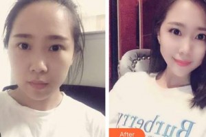 太原星范醫(yī)療美容門診部李凱整形價格表附切開雙眼皮案例展示