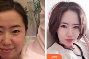 大同名仕醫(yī)療美容診所魯彥麟整形價格表附眼部綜合案例展示