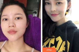 大同市第二人民醫(yī)院整形燒傷外科邢松山整形價格表附鼻部綜合案例展示