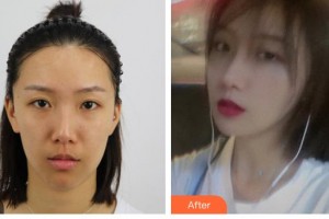 大同鳳凰婦產醫(yī)院整形美容科王艷波整形價格表附耳軟骨復合隆鼻案例展示