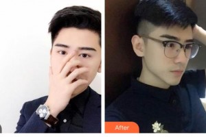 大同市第五人民醫(yī)院乳腺整形科魏學黎整形價格表附埋線提升案例展示