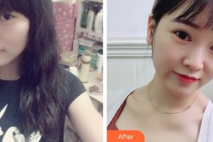 大同清木整形醫(yī)院崔虎院長整形價格表附埋線提升案例展示