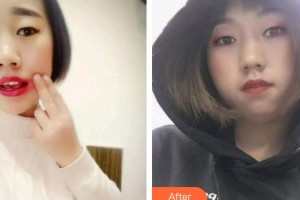 大同美神整形美容醫(yī)院王東整形價格表附根管調(diào)節(jié)案例展示