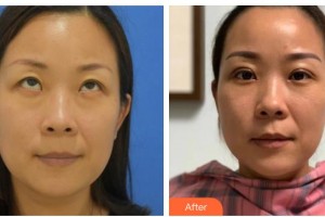 長(zhǎng)治同康眼科醫(yī)院馮江虹整形價(jià)格表附眼部綜合案例展示