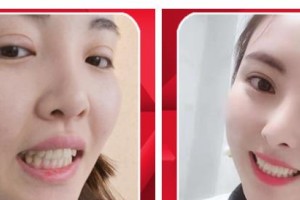 長(zhǎng)治億大口腔醫(yī)院張睿整形價(jià)格表附牙齒隱形矯正案例展示