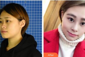 長(zhǎng)治同康眼科醫(yī)院朱思泉整形價(jià)格表附牙齒隱形矯正案例展示