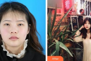 長治同康眼科醫(yī)院魏月蓮整形價(jià)格表附眼部綜合案例展示