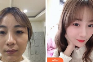 晉城鳳凰整形美容醫(yī)院李圣吉整形價(jià)格表附切開雙眼皮案例展示