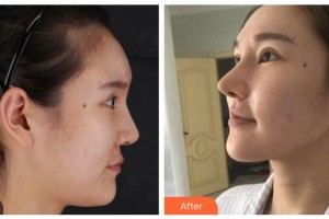 晉城市眼科醫(yī)院張進(jìn)軍整形價(jià)格表附切開雙眼皮案例展示