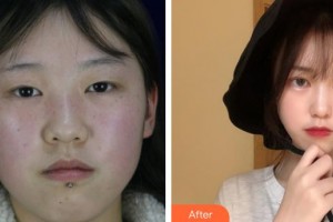 晉城市眼科醫(yī)院張蓉整形價(jià)格表附切開雙眼皮案例展示