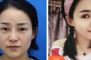 晉城鳳凰整形美容醫(yī)院李永立整形價(jià)格表附眼部綜合案例展示