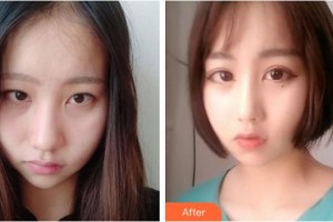 晉城現(xiàn)代女子醫(yī)院整形美容中心張建強(qiáng)整形價(jià)格表附外切祛眼袋案例展示