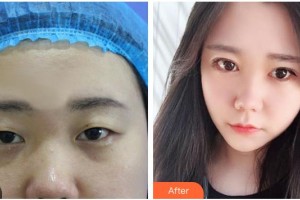 朔州麗都醫(yī)療整形美容醫(yī)院梁榮生整形價(jià)格表附切開雙眼皮案例展示