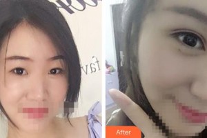 晉中鷹華眼科醫(yī)院惠延年整形價(jià)格表附眼部綜合案例展示