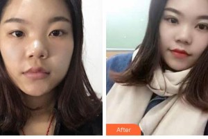 晉中鷹華眼科醫(yī)院褚仁遠(yuǎn)整形價(jià)格表附切開雙眼皮案例展示