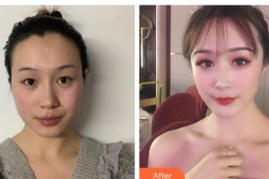 運城市第一醫(yī)院燒傷整形美容科郭靜整形價格表附自體脂肪全臉填充案例展示