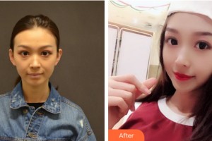 三亞維多利亞醫(yī)療美容醫(yī)院杜經(jīng)緯整形價(jià)格表附自體脂肪填充案例展示