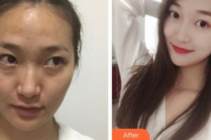 運城市中心醫(yī)院整形外科薛哲民整形價格表附彩光嫩膚案例展示