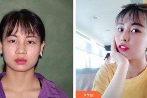 運城光子醫(yī)療美容門診部孫華剛整形價格表附鼻部綜合案例展示