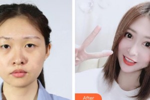 運城華美醫(yī)學美容醫(yī)院布萊恩整形價格表附假體隆胸案例展示