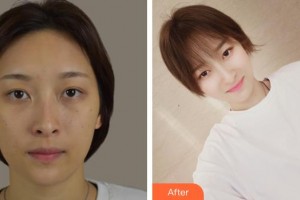 運城市皮膚病醫(yī)院醫(yī)學美容科郭紅磊整形價格表附清潔祛痘案例展示