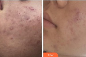 運城臻美整形美容醫(yī)院郝瑞鵬整形價格表附微針美膚案例展示