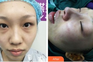 運城華美醫(yī)學美容醫(yī)院王惠民整形價格表附清潔祛痘案例展示