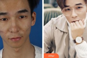 運城麗霞醫(yī)療美容診所嚴麗霞整形價格表附去痘印痘坑案例展示